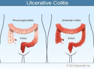 When I was first "scoped," my colon looked like the one on the right.