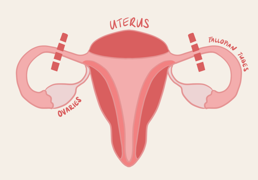 A simple drawing of a uterus. A dotted line marks where incisions would be made on the Fallopian tubes during tubal ligation.